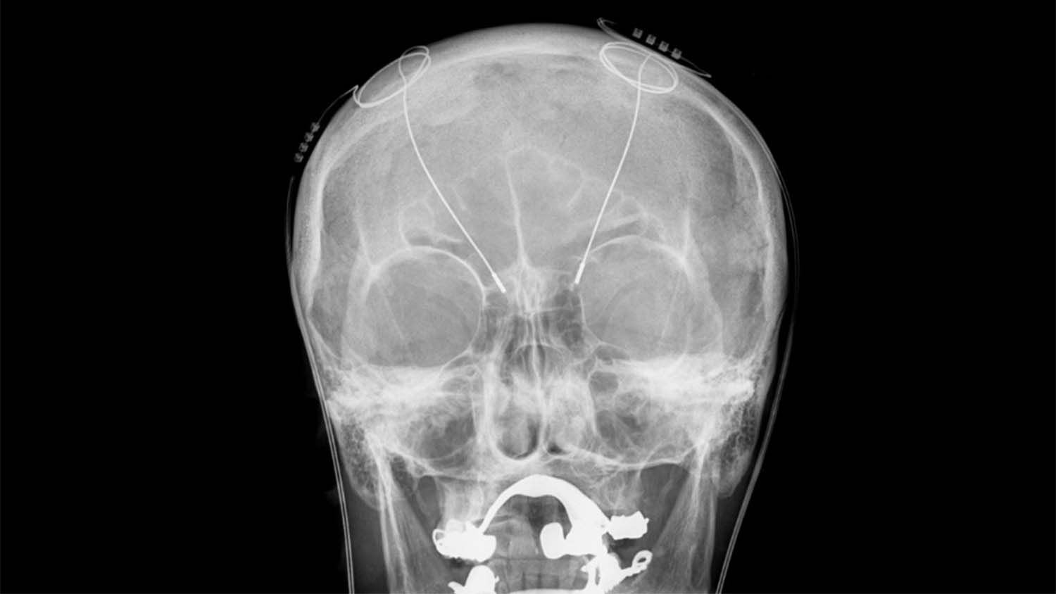 x光片显示了植入人脑的电极